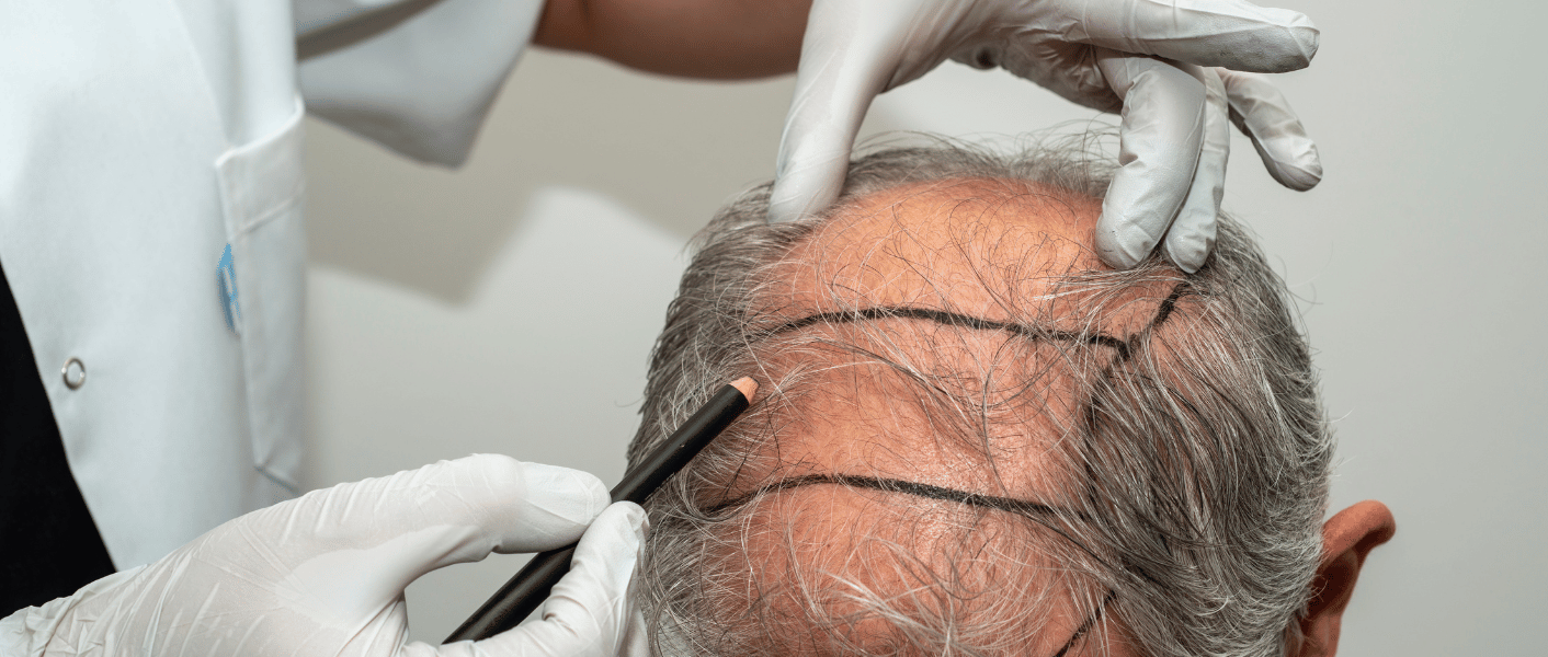Bio fue benefit for hair transplant